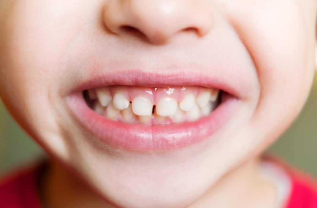 baby teeth children dentistry