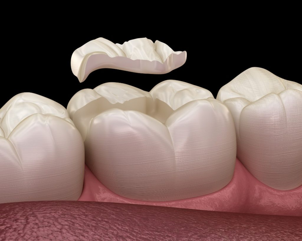 tooth filling falling out,